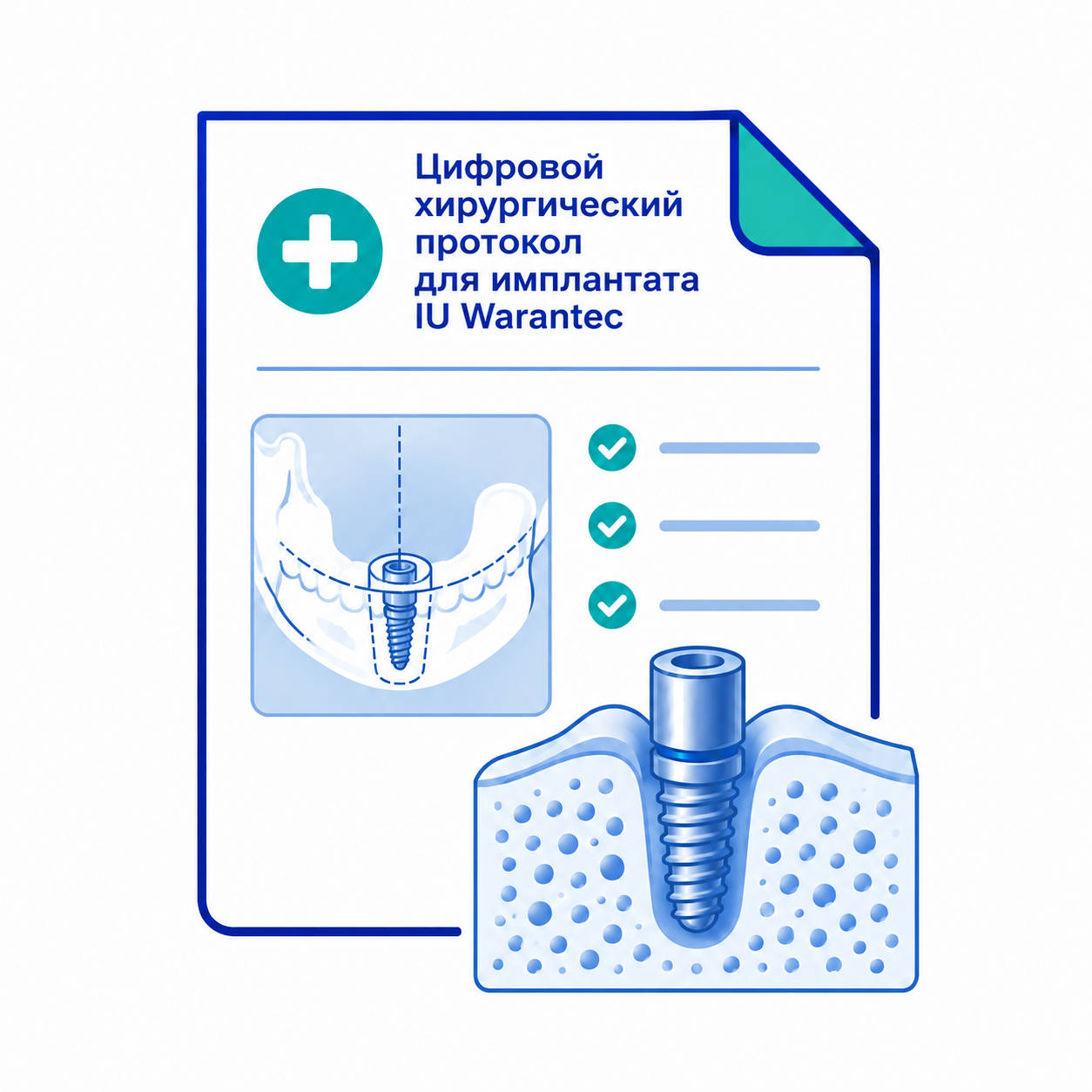 Цифровой хирургический протокол для имплантата IU Warantec